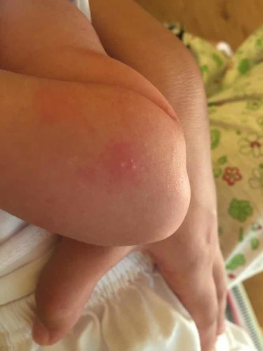 Insect bites