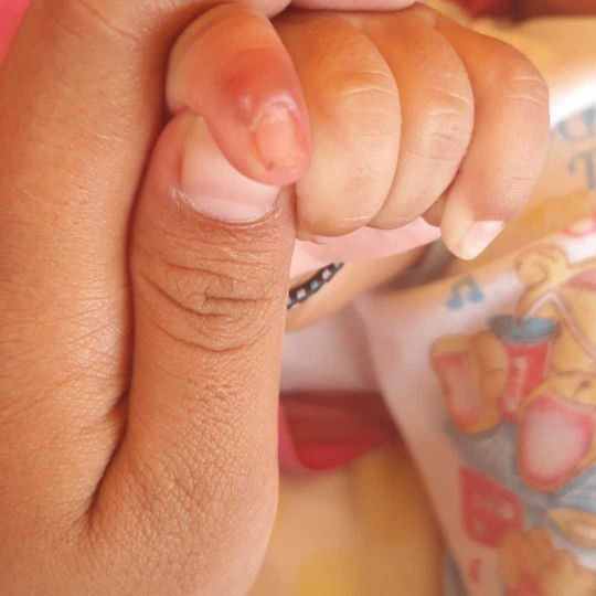 luka2 di sekitar kuku