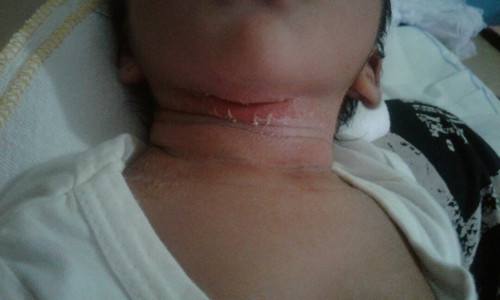 rashes