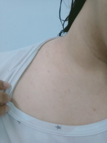 แม่ๆคนไหนท้องแล้วมีตุ้มแดงๆขึ้นแบบนี้บ้างคะ