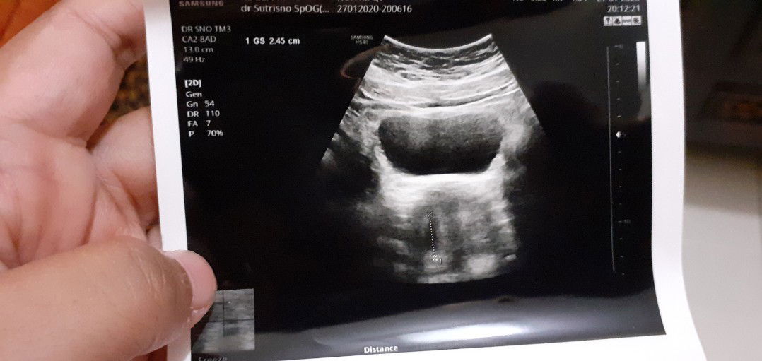 kantung kehamilan lonjong