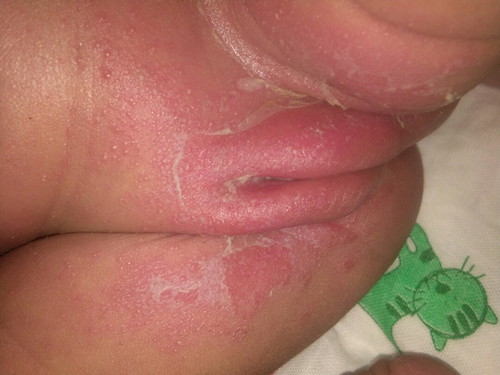น้องแพ้แพมเพิส เป็นผื่น ผิวถลอกหนักมาก