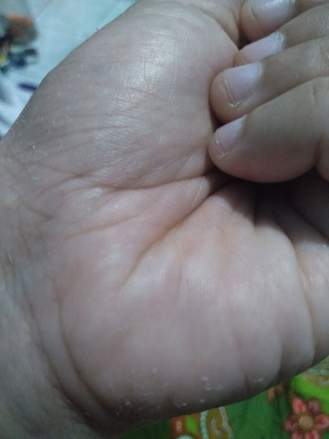 kulit kering dan kasar d bagian telapak tagan