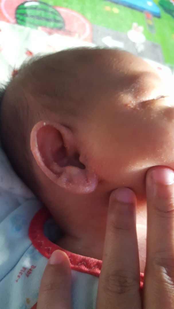 Ruam di muka telinga dan leher