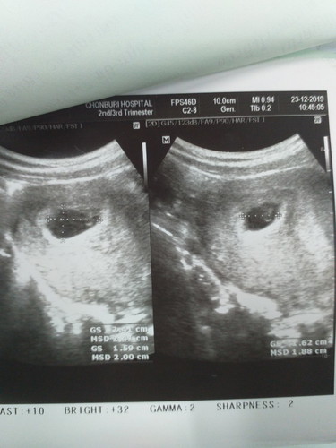 มีถุงตั้งครรภ์แต่ยังไม่เห็นตัวเด็ก