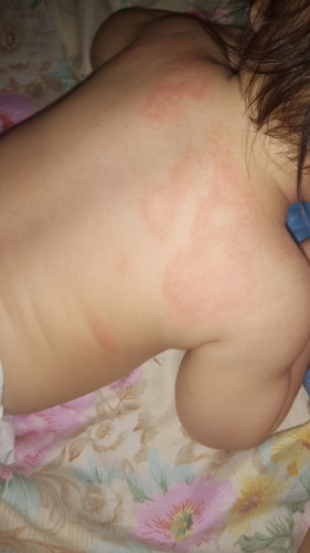Rashes