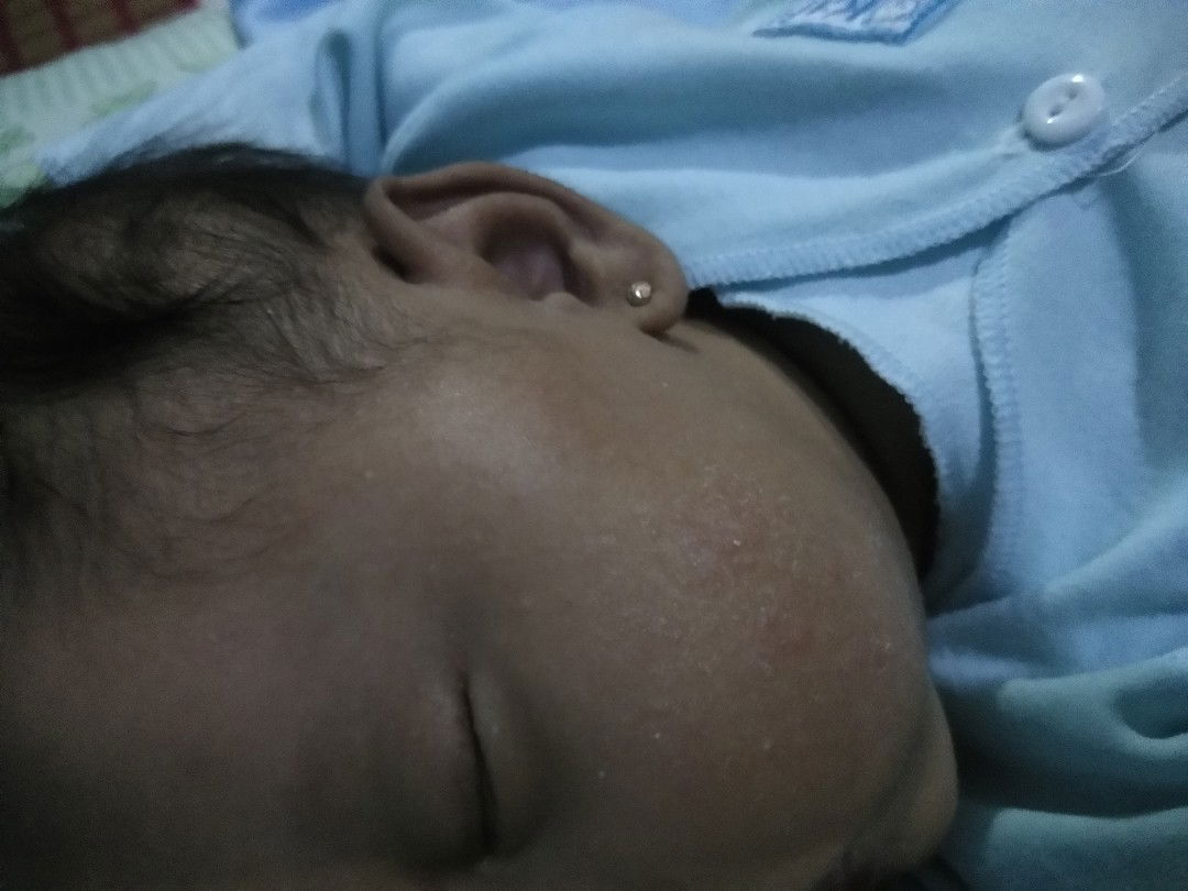 bintik merah di muka