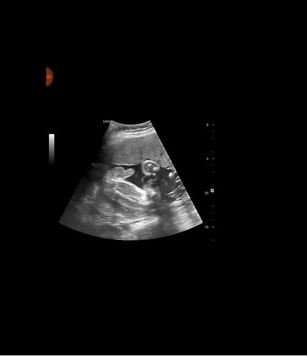 Rahim terbalik Dan Ectopic berjaya hamil