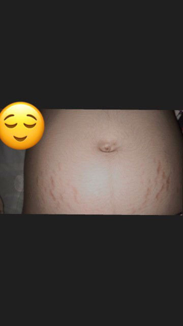 stretch mark saat hamil