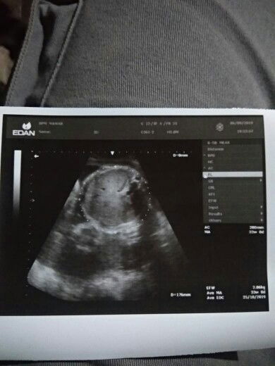 USG baby pertama ku ?