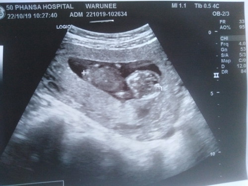 เเม่ๆรู้สึกยังไงบ้างได้เห็นลูกครั้งเเรก