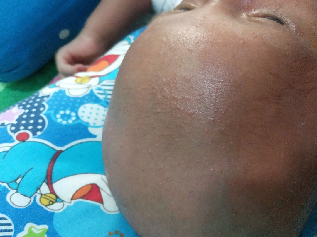 bintik bintik dikepala dan wajah bayi