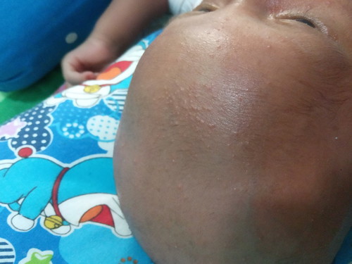 bintik bintik dikepala dan wajah bayi