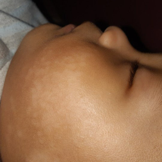 Pityriasis alba
