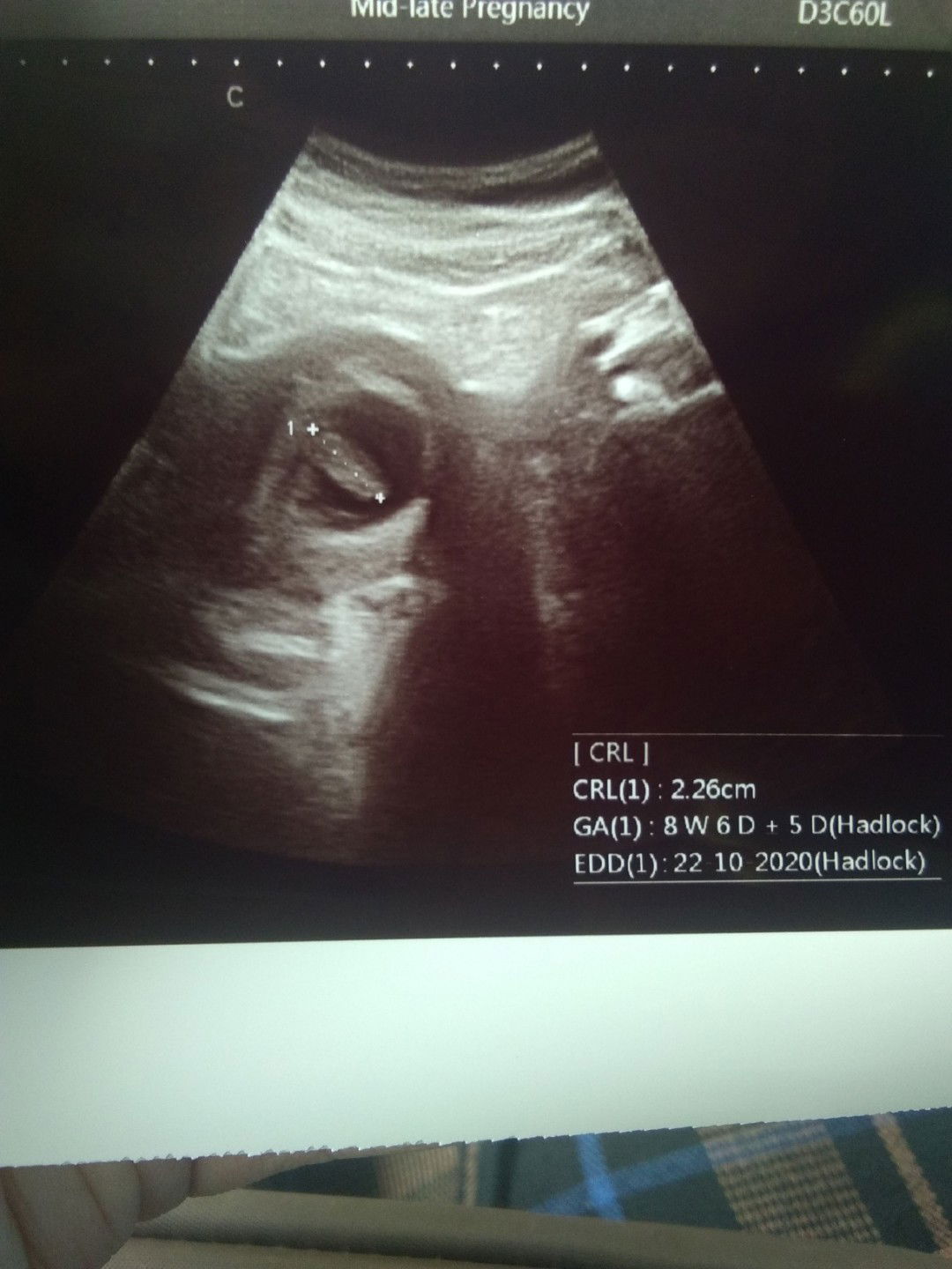 Sharing buat bunda yang ngalamin pendarahan