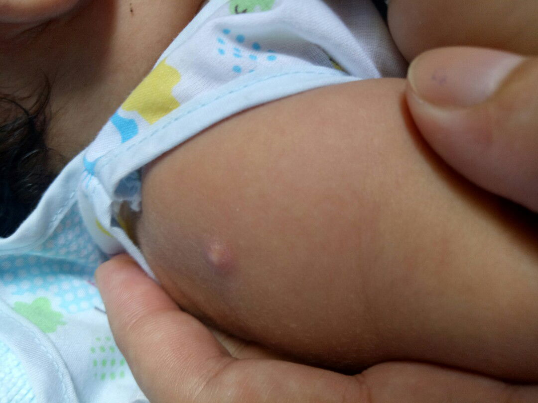 น้องมีตุ่มที่ไหลคล้ายหนอง