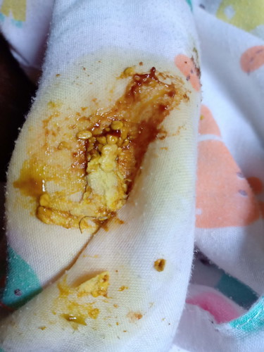 ลูก 5เดือนถ่ายมีเลือด