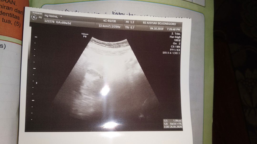 bingung UK kehamilan
