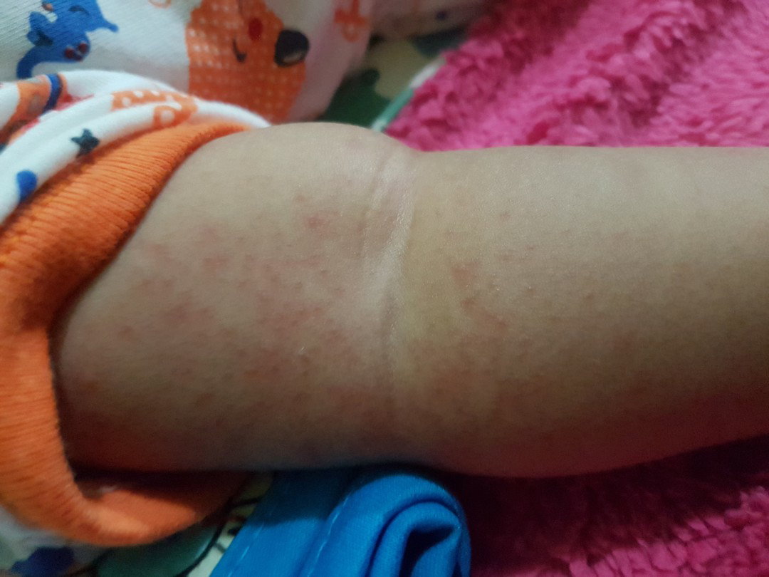 kemerahan pada bayi