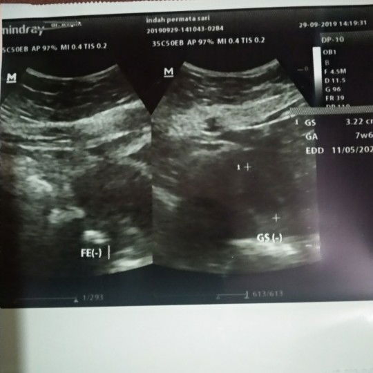USG Kehamilan