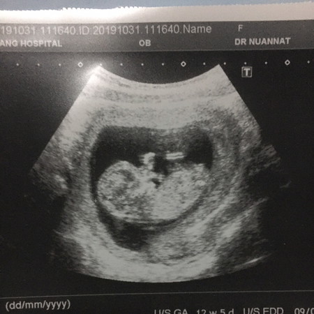 ท้องไม่ใหญ่