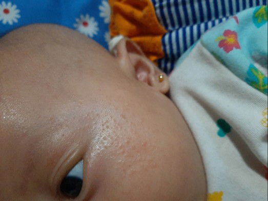 Bintik* di wajah bayi