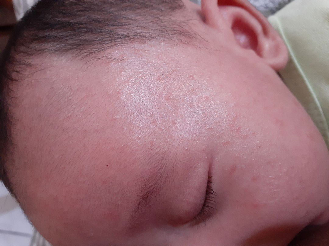 wajah bayi beruntusan