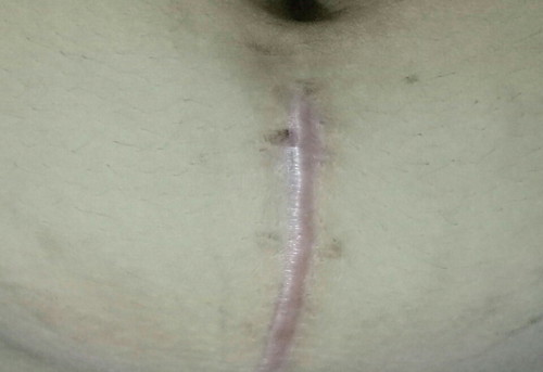 caesarian scar