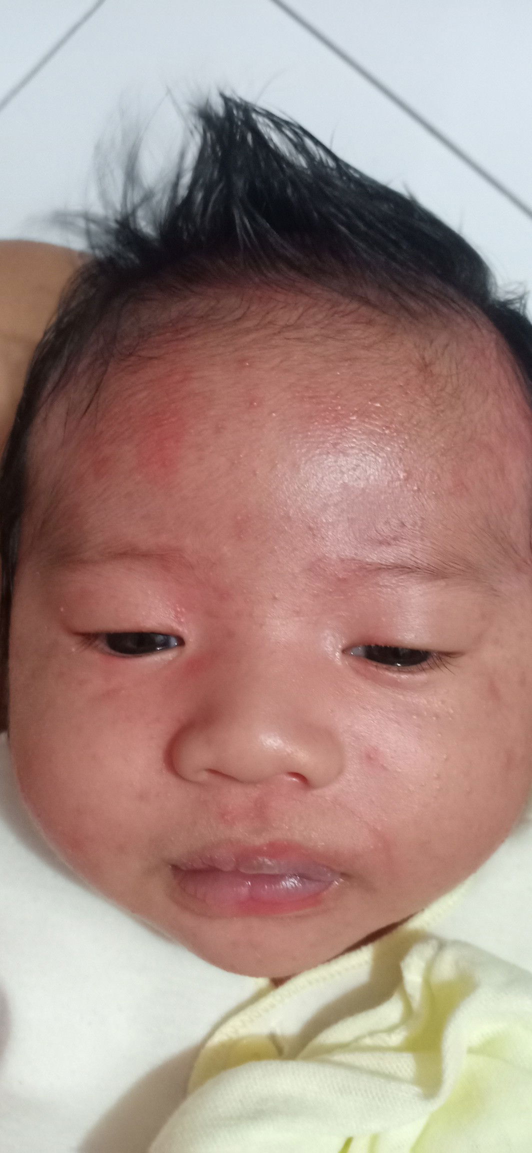 Wajah bruntusan kemerahan