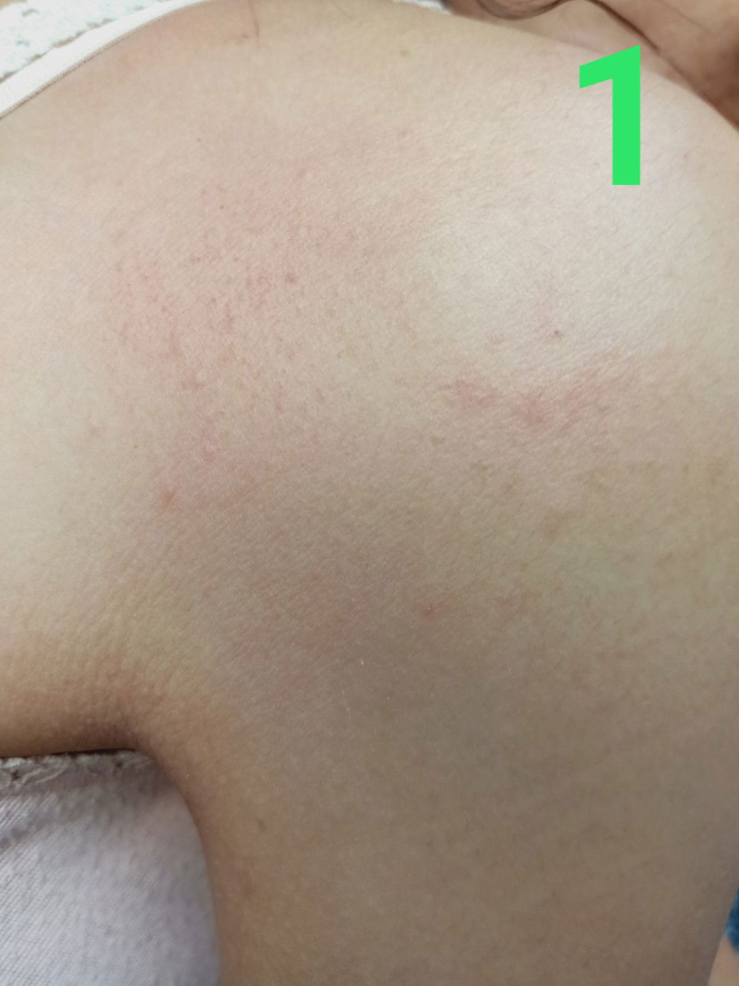 ผื่นขึ้นที่ไหล่ปกติเขาเป็นกันไหม