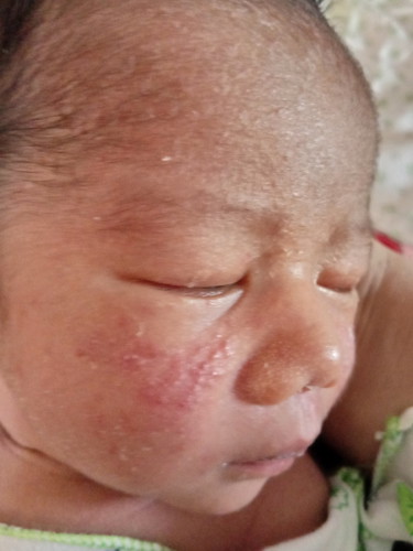 ทำไงดีคะลูกมีผื่นแดงๆ