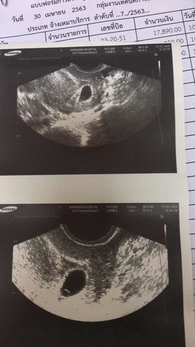 6 week HCG=56,901 น่ากังวลไหม