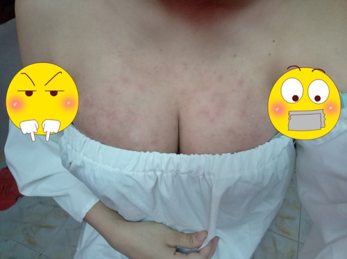 ช่วยด้วยค่ะ ผื่นขึ้นหน้าอกหนักมากกก