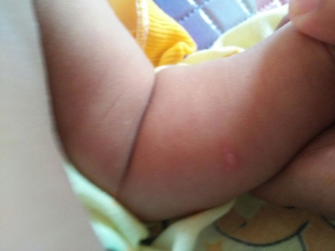 ada seperti jerawat/luka bakar pada bayi