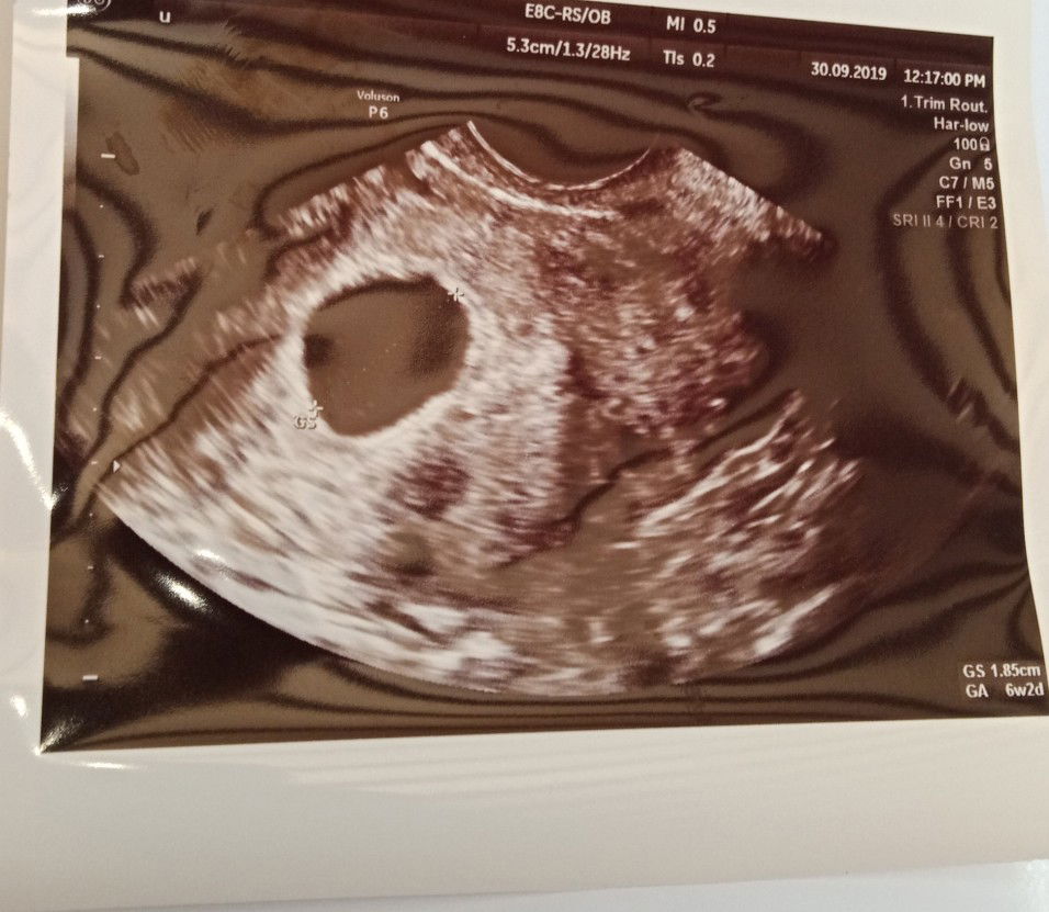 Usia Kandungan Tak Sama Dengan Scan