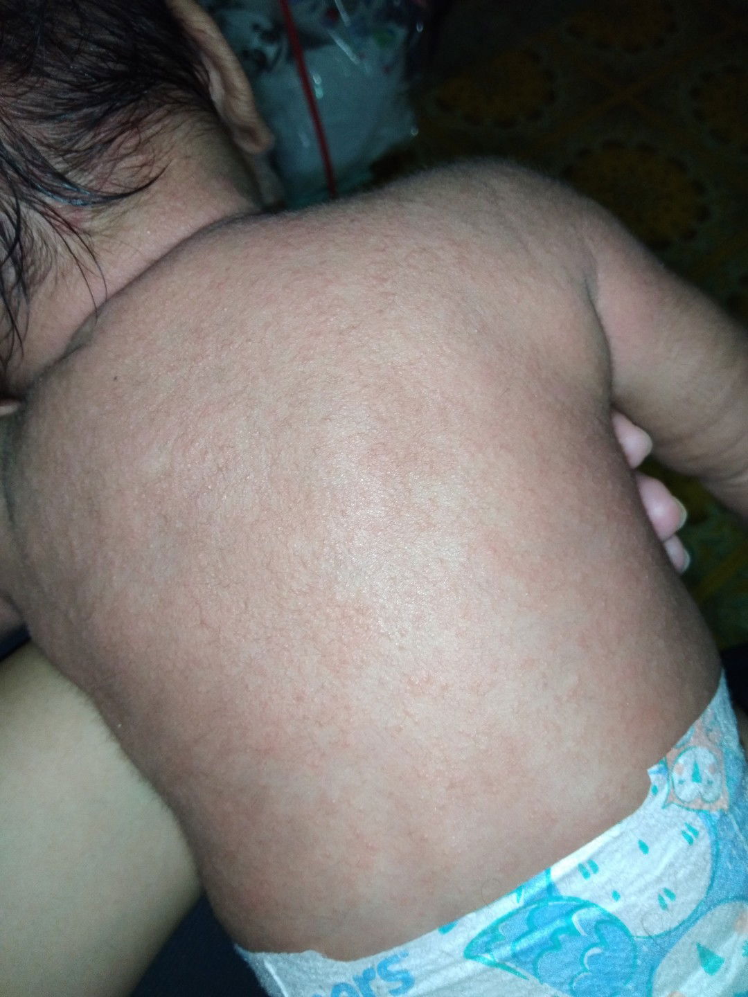 badan anak saya naik bintik bintik mengerutu .