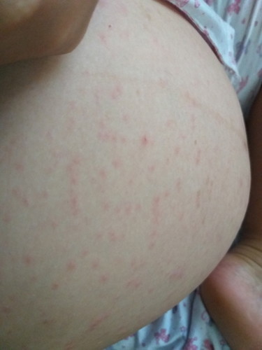 ผื่นคัน