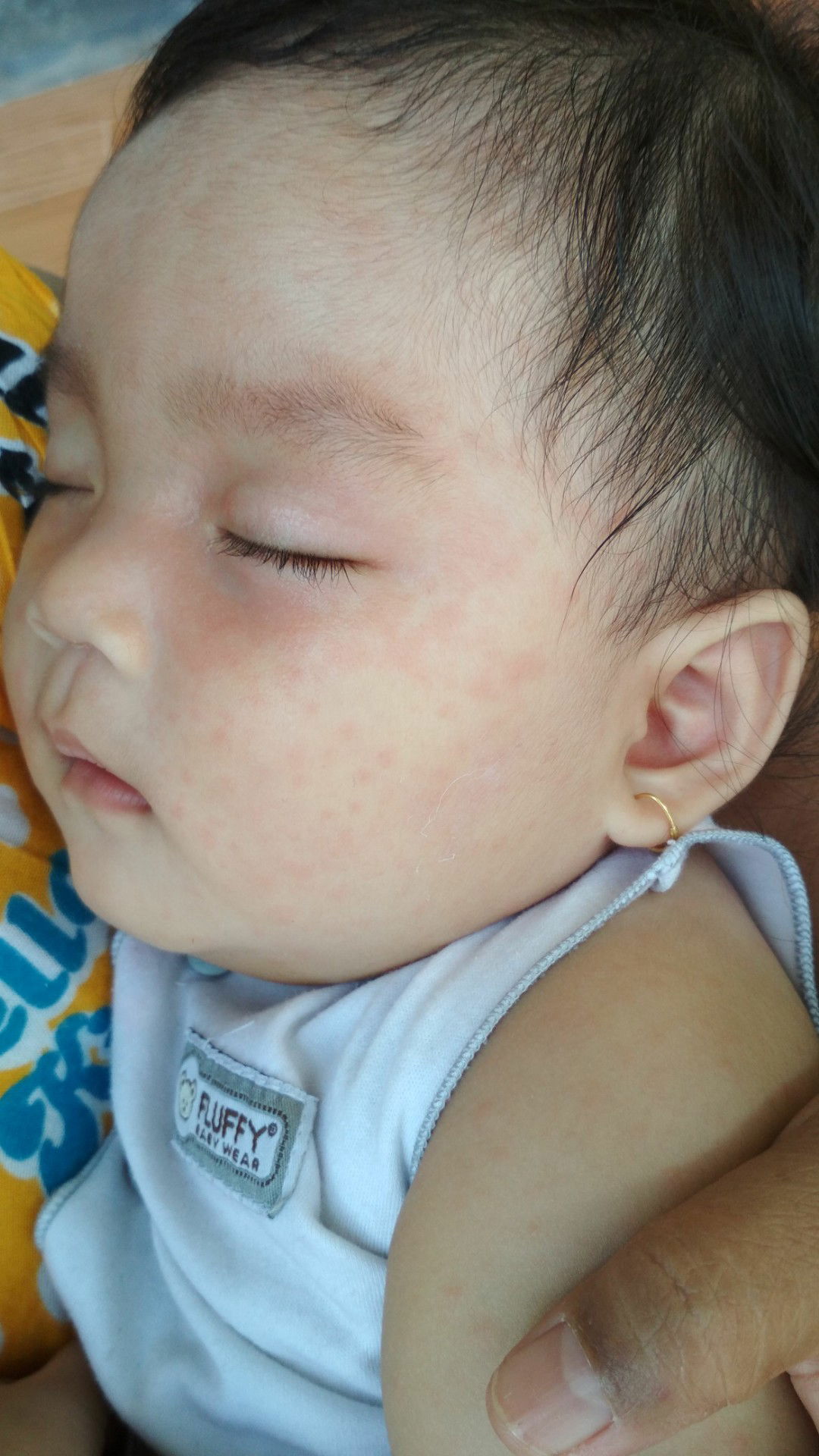 rubella?roseola?ato campak?