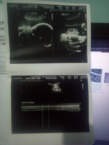 Ultrasound