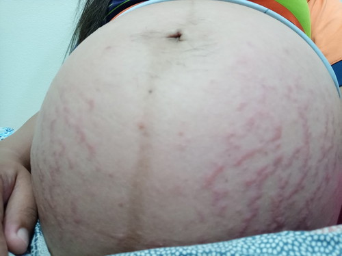 ท้องแตกหนักมาก