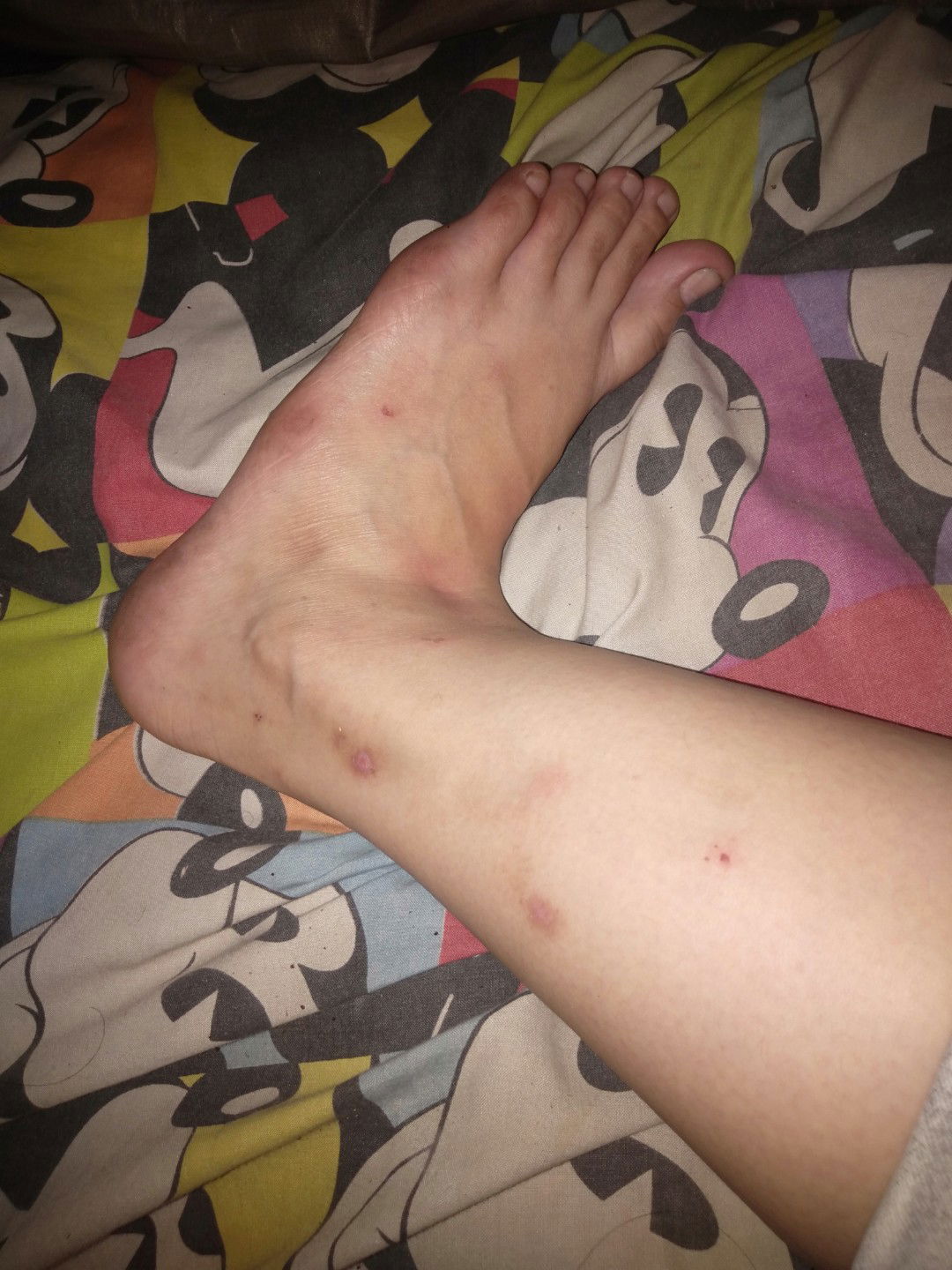 gatel ditangan dn dikaki