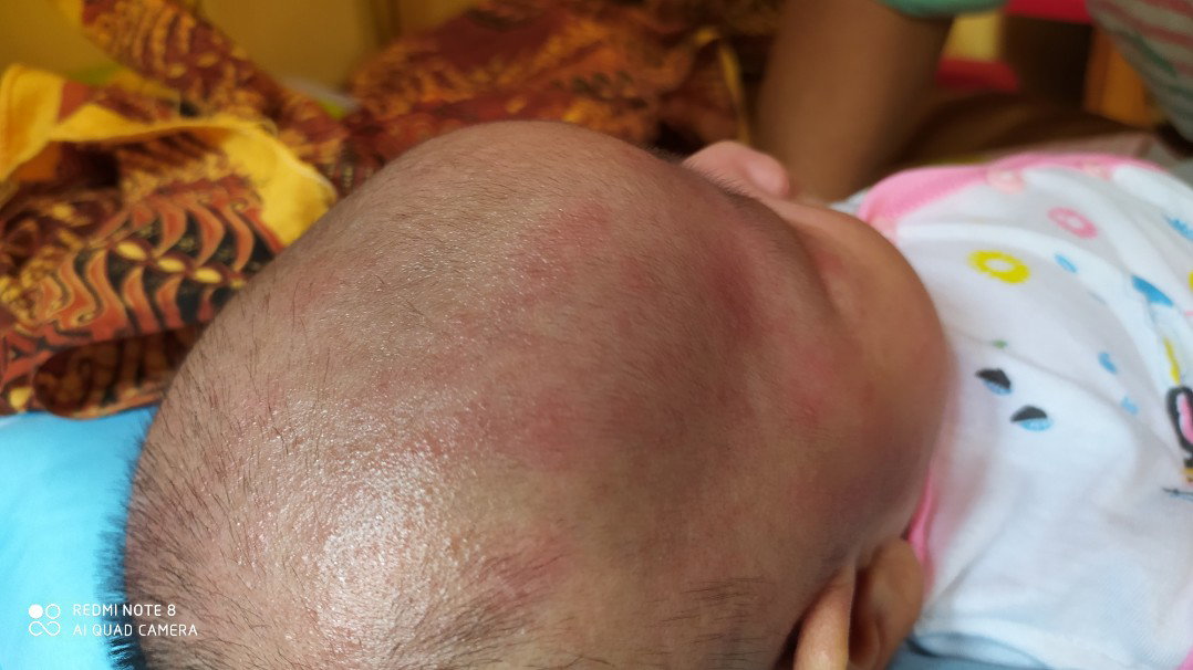 beruntusan/ ruam di wajah bayi
