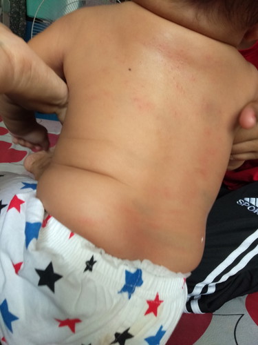 หลังแแดง