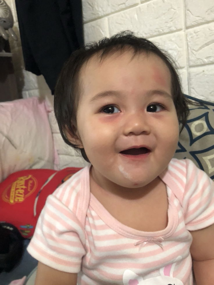 Is my daughter get Allergy ?