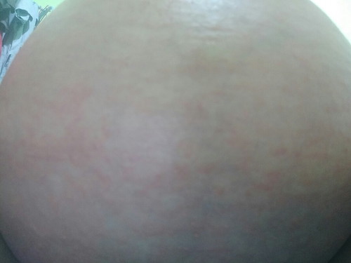 เป็นผื่นคันที่ท้อง