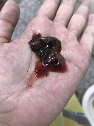 เมื่อวานคุณหมอกระตุ้นปากมดลูก 39 week