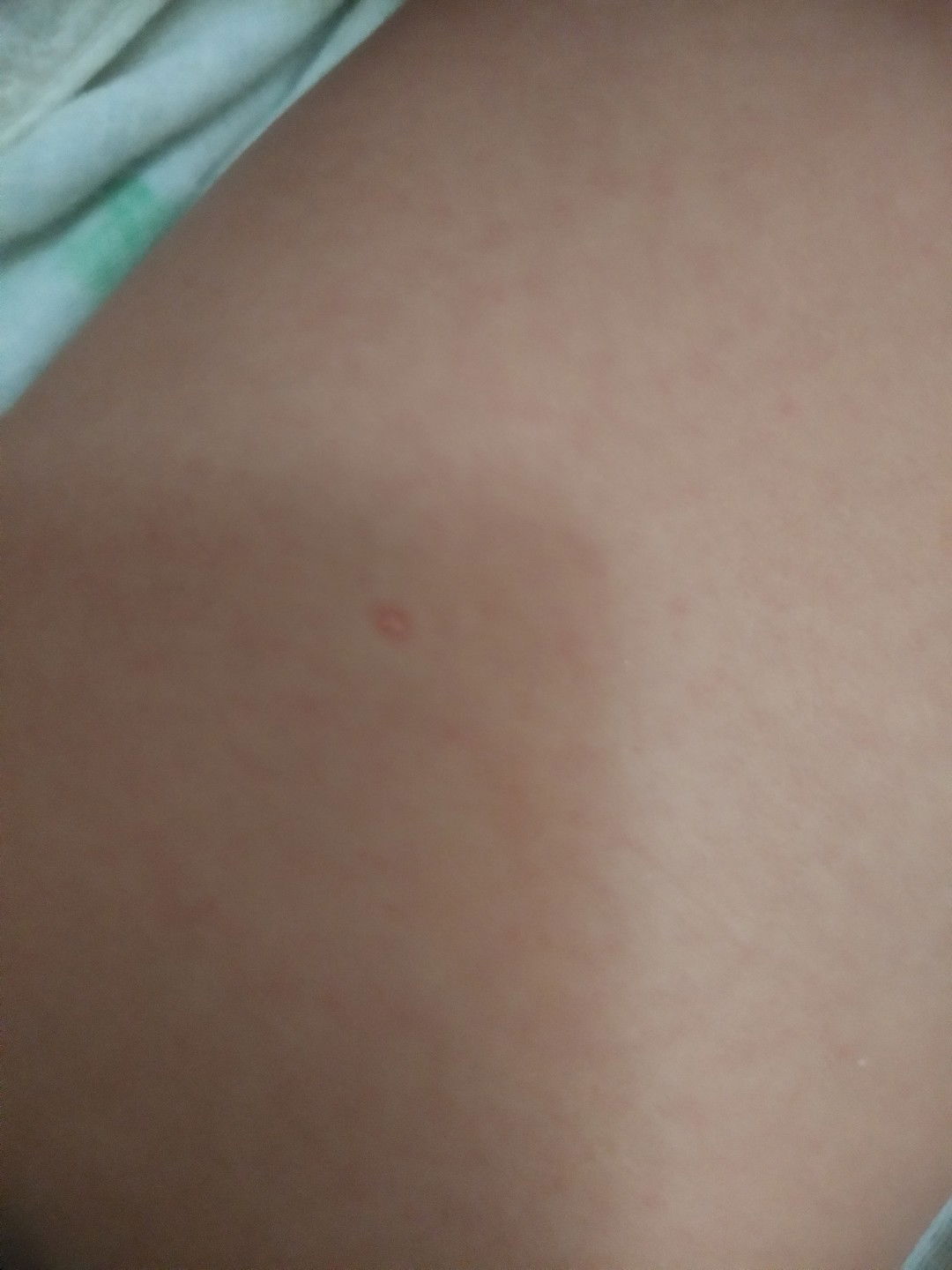 baby 2 bulan kena cacar