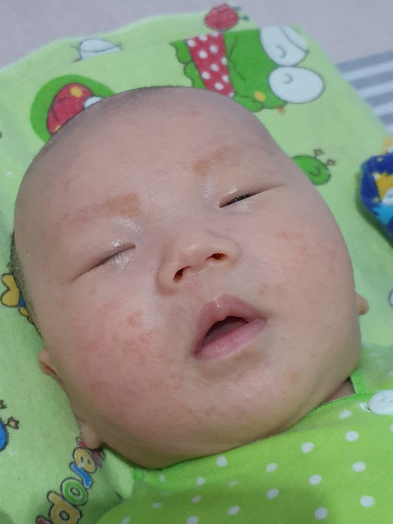 wajah bayi alergi