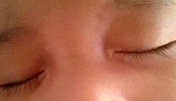 bercak putih pada kelopak mata