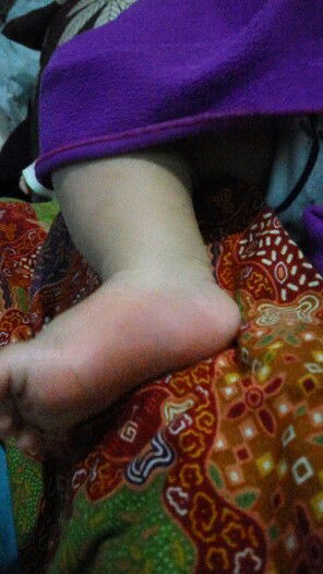 telapak kaki kemerahan